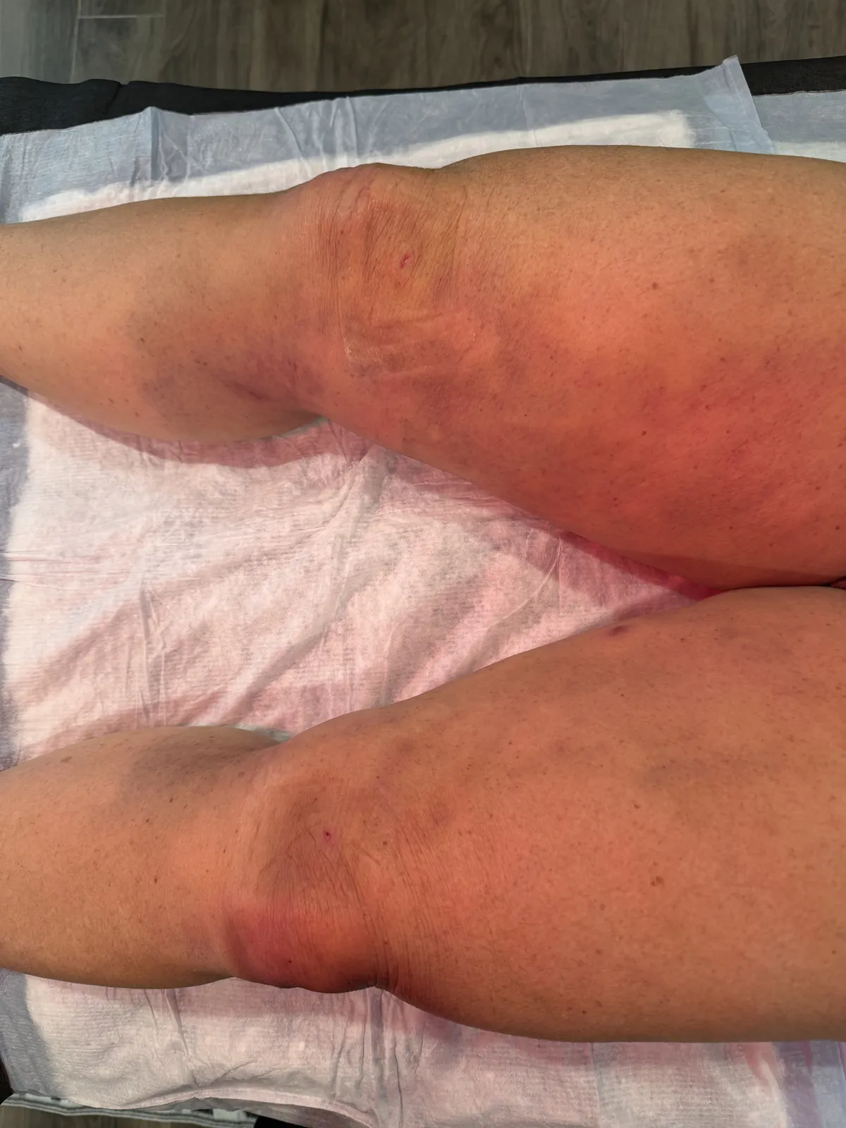 Leg surgery